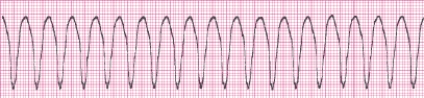 Identify the following rhythm (lead II): ____________________   