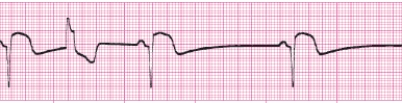 Identify the following rhythm (lead II): ____________________   