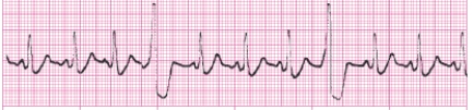 Identify the following rhythm (lead II): ____________________   