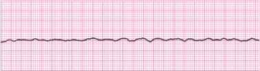 Identify the following rhythm (lead II): ____________________   