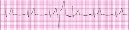 Identify the following rhythm (lead II): ____________________   