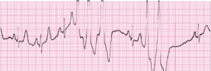 Identify the following rhythm (lead II): ____________________   