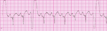 Identify the following rhythm (lead II): ____________________   