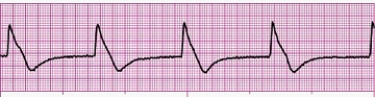 Identify the following rhythm (lead II): ____________________   