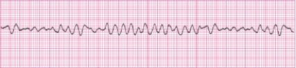 Identify the following rhythm (lead II): ____________________   