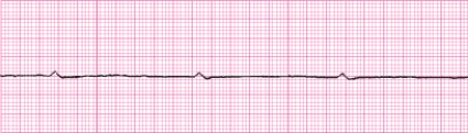 Identify the following rhythm (lead II): ____________________   