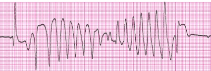 Identify the following rhythm (lead II): ____________________   