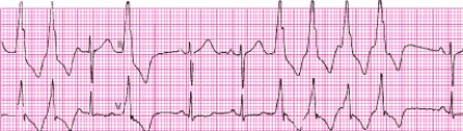Identify the following rhythm: ____________________   