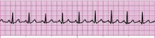 Identify the following rhythm (lead II): ____________________   
