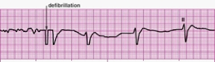 Identify the following rhythm (lead II): ____________________   