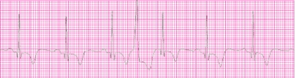 Identify the following rhythm (lead II): ____________________   