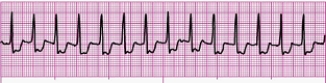 Identify the following rhythm (lead II): ____________________   