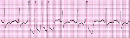 Identify the following rhythm (lead II): ____________________   