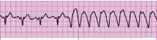 Identify the following rhythm (lead II): ____________________   