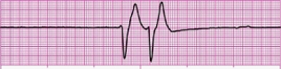 Identify the following rhythm (lead II): ____________________   
