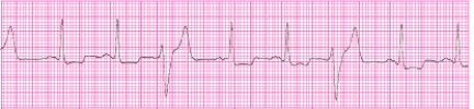 Identify the following rhythm (lead II): ____________________   