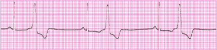 Identify the following rhythm (lead II): ____________________   