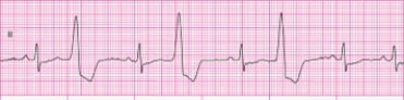 Identify the following rhythm: ____________________   