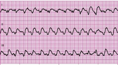 Identify the following rhythm: ____________________   