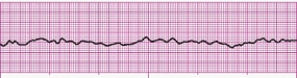 Identify the following rhythm (lead II): ____________________   