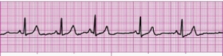 Identify the following rhythm (lead II): ____________________   