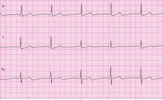Identify the following rhythm: ____________________   