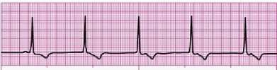 Identify the following rhythm (lead II): ____________________   
