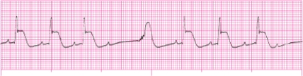Identify the following rhythm: _________________________   