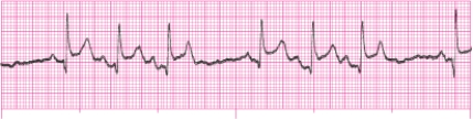 Identify the following rhythm: _________________________   