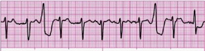 Identify the following rhythm: _________________________   