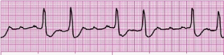 Identify the following rhythm: _________________________   