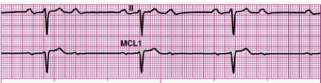 Identify the following rhythm: _________________________   