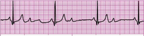 Identify the following rhythm: _________________________   
