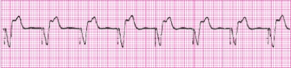 Identify the following rhythm: _________________________   