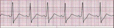Completion -Identify the following rhythm (lead II): ____________________   