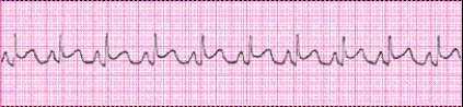 Completion -Identify the following rhythm (lead II): ____________________   