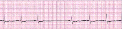 Completion -Identify the following rhythm (lead II): ____________________   