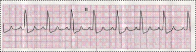Completion -Identify the following rhythm: ____________________   