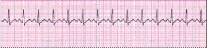 Completion -Identify the following rhythm (lead II): ____________________   