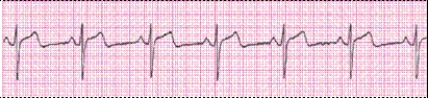 Completion -Identify the following rhythm (lead II): ____________________   