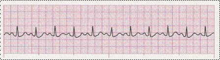 Completion -Identify the following rhythm (lead II): ____________________   