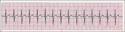 Completion -Identify the following rhythm (lead I): ____________________   