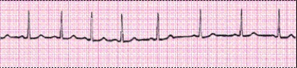Identify the following rhythm (lead II): ____________________