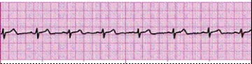 Completion -Identify the following rhythm (lead II): ____________________   