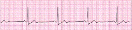Completion -Identify the following rhythm (lead II): ____________________   