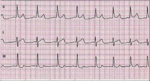 Completion -Identify the following rhythm: ____________________   