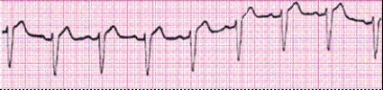 Completion -Identify the following rhythm (lead II): ____________________   