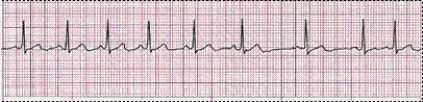 Completion -Identify the following rhythm (lead II): ____________________   