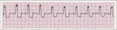 Completion -Identify the following rhythm (lead II): ____________________   