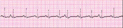 Identify the following rhythm (lead II) .   A)  Atrial fibrillation B)  Sinus arrhythmia C)  Multifocal atrial tachycardia D)  Sinus tachycardia with premature atrial complexes (PACs) 